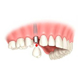 Implante dental una sola pieza