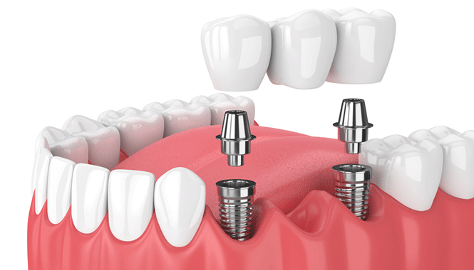 Los implantes también pueden ayudarte a mejorar la estética y funcionalidad de tu boca