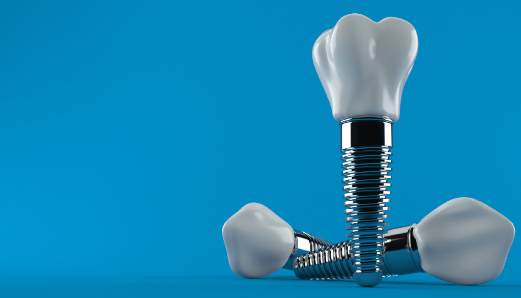 Implantes dentales, ocho cosas que debes conocer