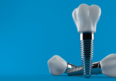 Implantes dentales, ocho cosas que debes conocer